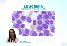 Leucemia Mielóide Aguda (LMA)